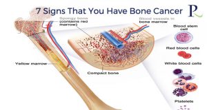 7 Signs That You Have Bone Cancer