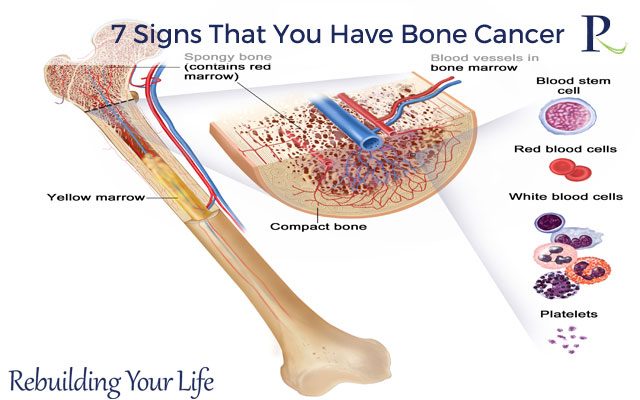 7 Signs That You Have Bone Cancer