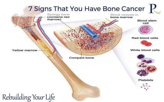 Read about 7 Signs That You Have Bone Cancer