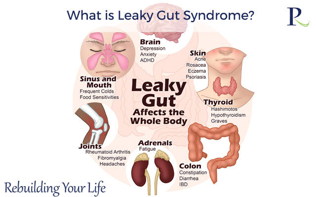 What is Leaky Gut Syndrome?