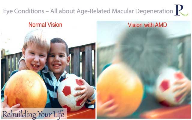 Eye Conditions – All about Age-Related Macular Degeneration