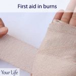 First aid in burns