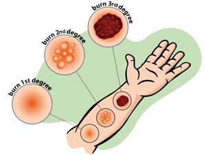 First aid in third-degree burns