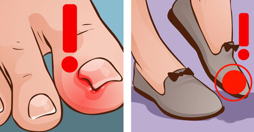 How to prevent ingrown nails