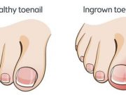 Learn how to prevent ingrown toenails