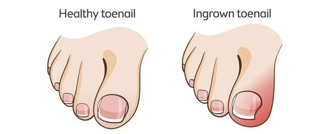 Learn how to prevent ingrown toenails