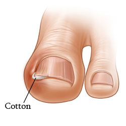 Technique of cotton wool for ingrown nails